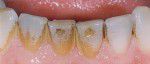 verfärbte Zähne